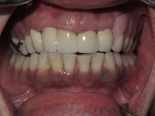 Using Crowns and a Removable Bridge to Restore