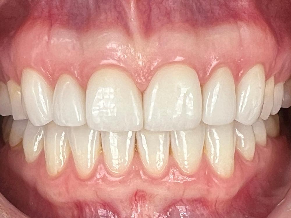 New Veneers
