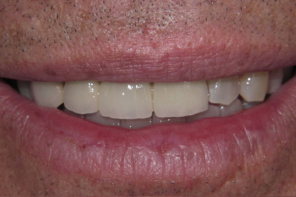 After image