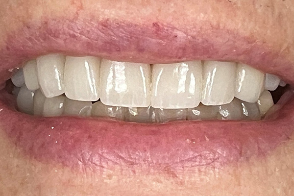 After image