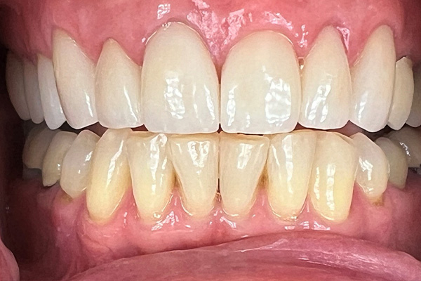 After image