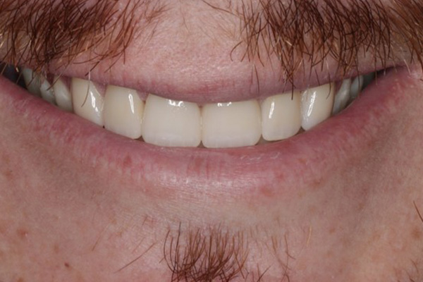 After image