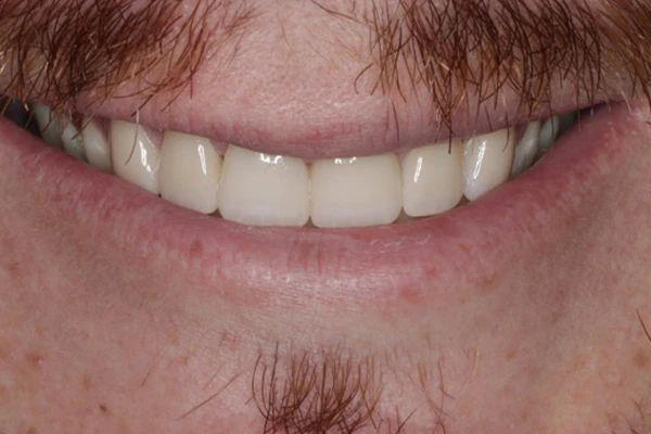 After image