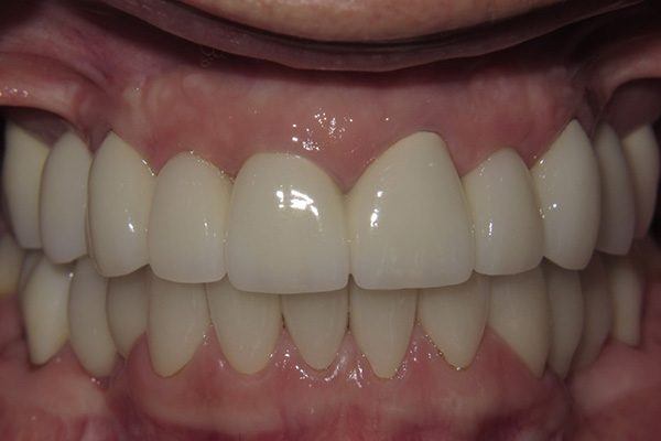 After image