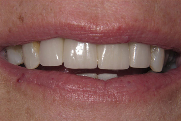 After image