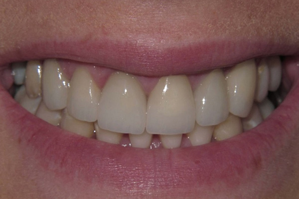 After image