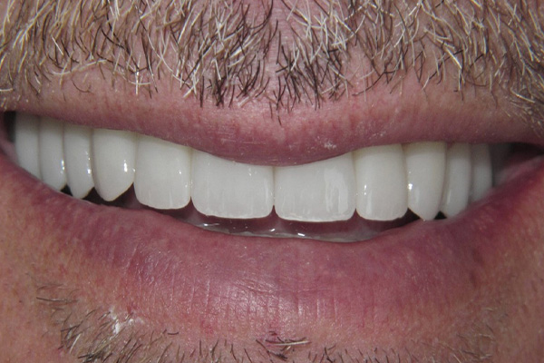 After image