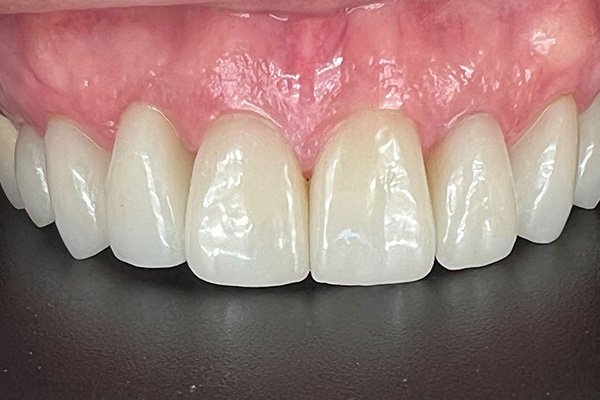 After image