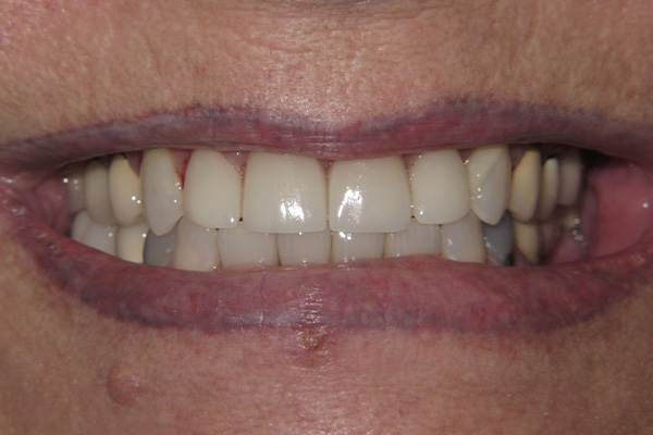 After image