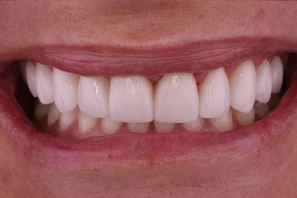 After image