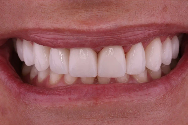 After image