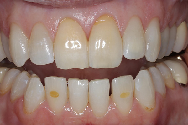 After image